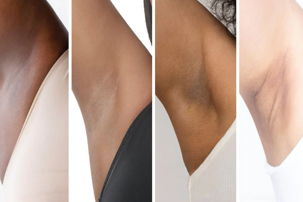 armpit pigmentation